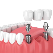 Địa chỉ trồng răng Implant uy tín tại TPHCM